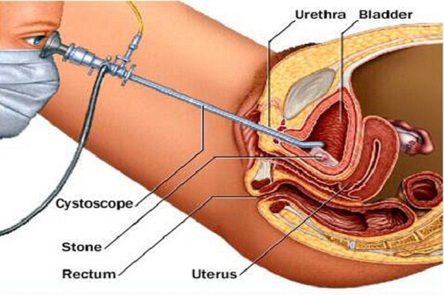 Cần cảnh giác với hiện tượng sỏi thận chạy xuống bàng quang