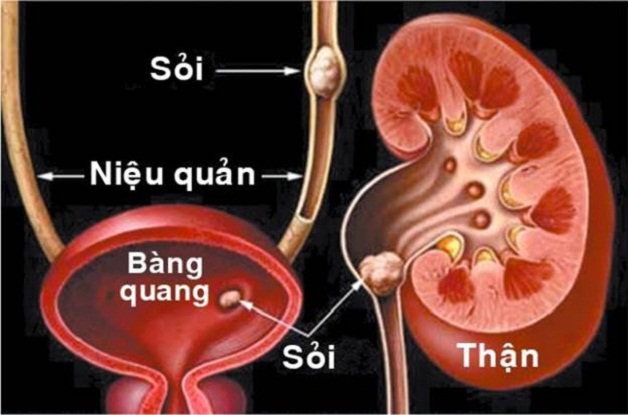 Cần cảnh giác với hiện tượng sỏi xuống bàng quang