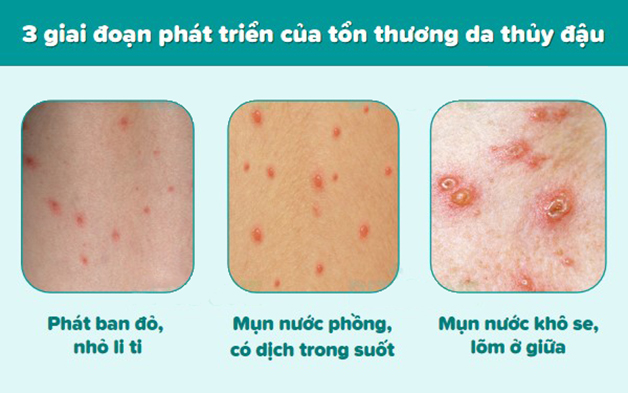 Cận cảnh hình ảnh các giai đoạn bệnh thủy đậu ở trẻ