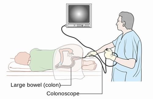 Cần làm gì trước khi nội soi đại tràng?