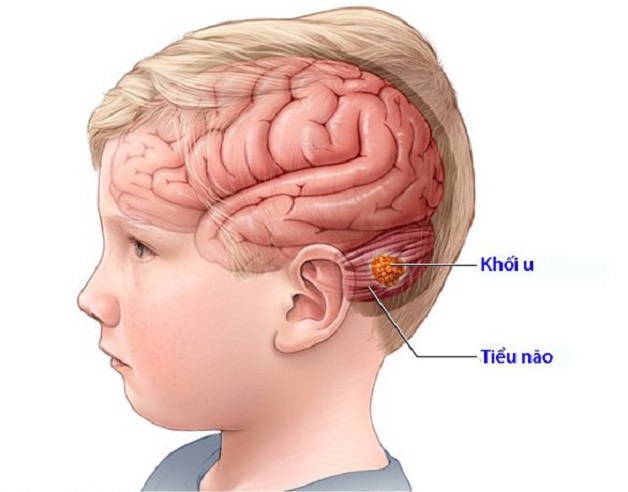 Cần lưu ý gì khi chụp MRI não cho trẻ em?