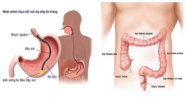 Cần lưu ý gì khi nhịn ăn để nội soi dạ dày?