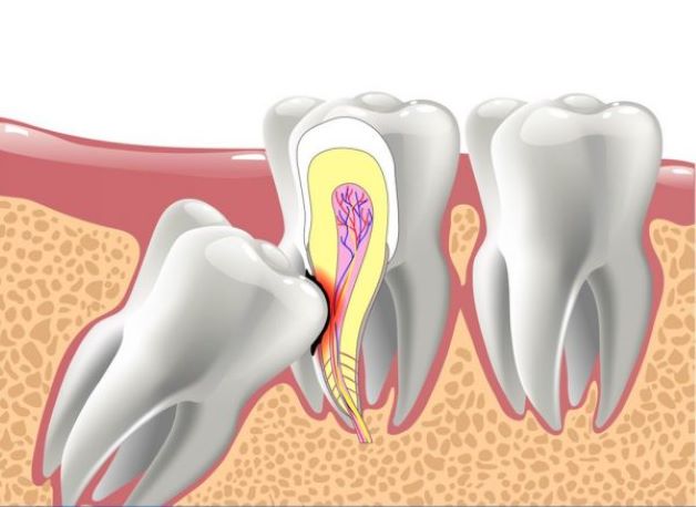 Cần lưu ý những gì khi nhổ răng khôn số 8?