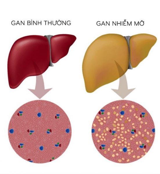 Cần phải làm gì khi mắc gan nhiễm mỡ?