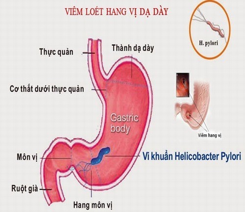 Cẩn thận với viêm xung huyết hang vị dạ dày