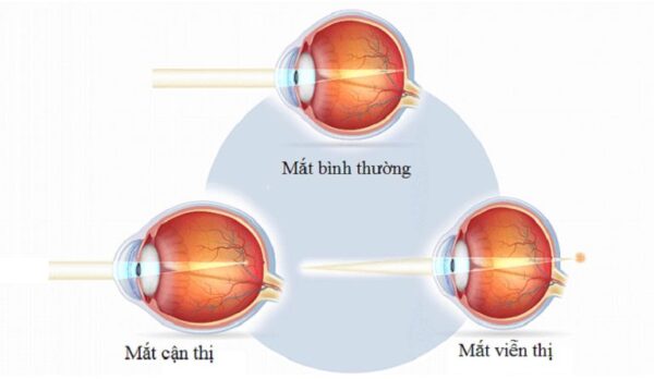 Cận thị và viễn thị là gì? Nguyên nhân và cách điều trị