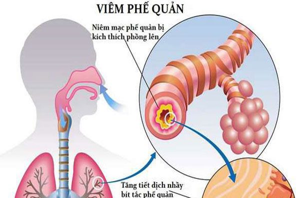 Cẩn trọng với bệnh viêm phế quản ở trẻ em mùa nắng nóng