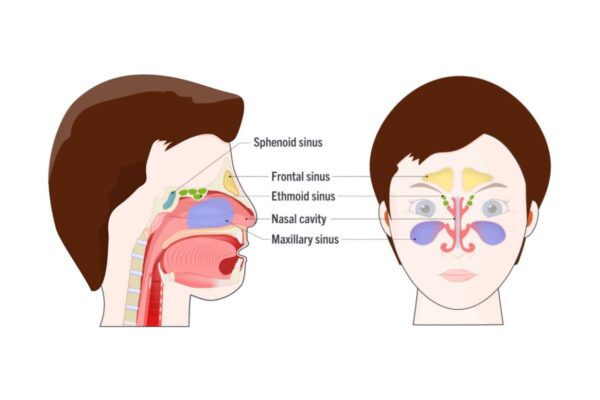 Cẩn trọng với những biến chứng do viêm xoang