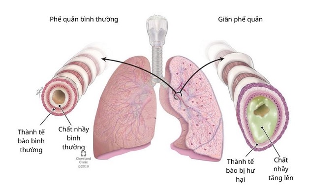 Cẩn trọng với triệu chứng giãn phế quản ho ra máu