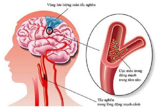 Cần xử trí thế nào khi cơn đột quỵ xảy ra?