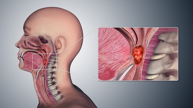 Cảnh báo 6 triệu chứng ung thư vòm họng