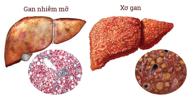 Cảnh báo biến chứng nguy hiểm của gan nhiễm mỡ