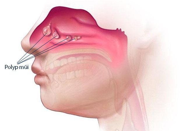 Cảnh báo biến chứng nguy hiểm từ bệnh viêm xoang cánh bướm