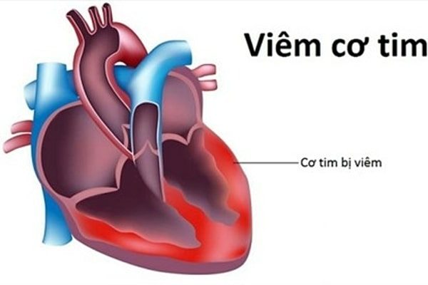 Cảnh báo các dấu hiệu bệnh viêm cơ tim cần nhập viện sớm