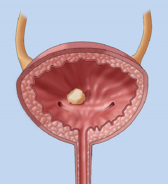Cảnh báo dấu hiệu của sỏi bàng quang người bệnh cần biết