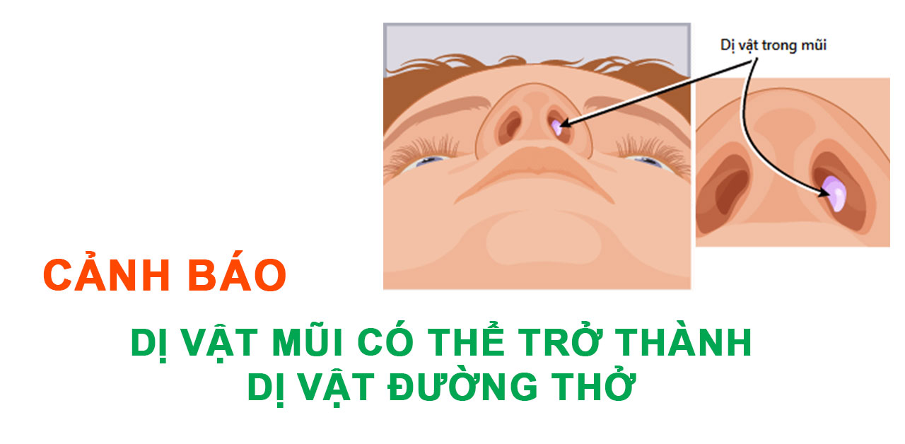 Cảnh báo: Dị vật đường mũi có thể trở thành dị vật đường thở