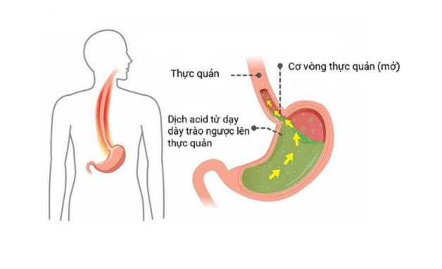 Cảnh báo nguy cơ khi trào ngược dạ dày lên mũi