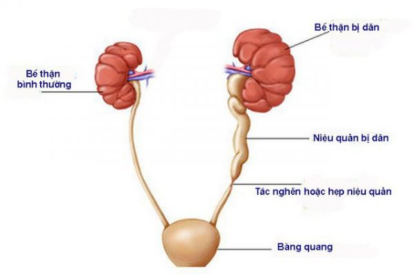 Cảnh báo những biến chứng nguy hiểm từ sỏi niệu quản