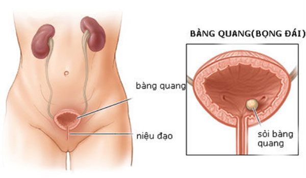 Cảnh báo những biến chứng sỏi bàng quang nguy hiểm