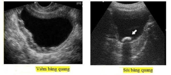 Cảnh báo những biến chứng sỏi bàng quang nguy hiểm