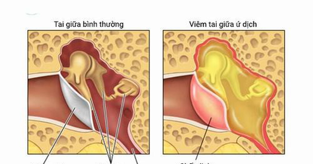 Cảnh báo những biểu hiện viêm tai giữa điển hình ở trẻ em