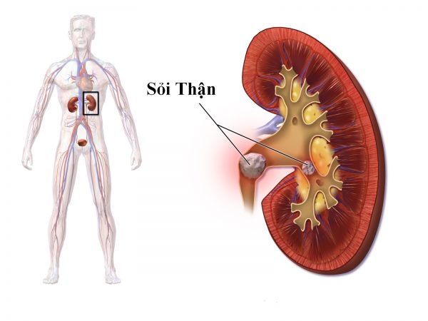 Cảnh báo những nguy hiểm từ sỏi thận 1cm