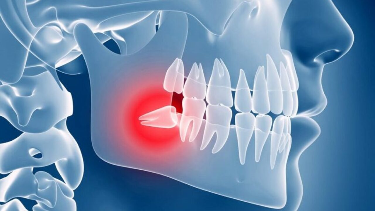 Cảnh báo tác hại khi không nhổ răng khôn mọc lệch