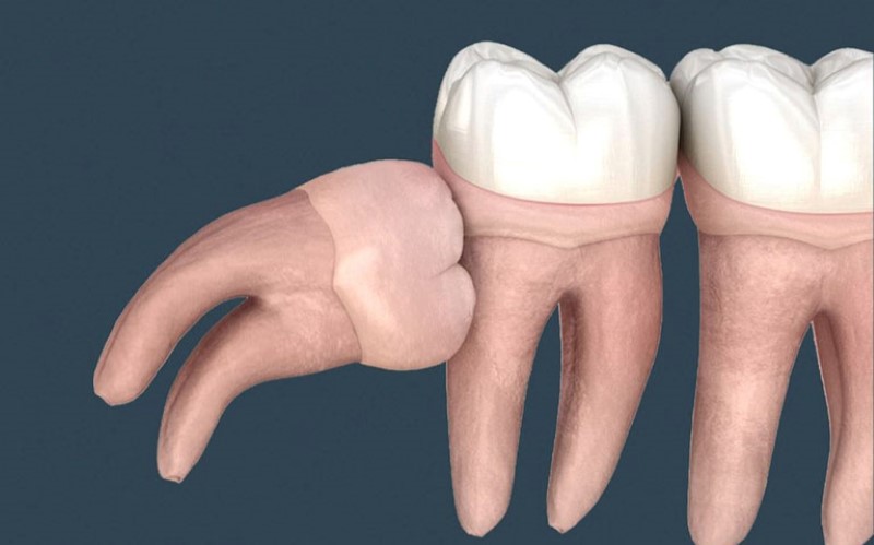 Cảnh báo tác hại khi không nhổ răng khôn mọc lệch