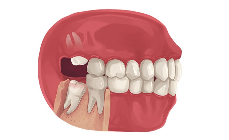 Cảnh báo tác hại khi không nhổ răng khôn mọc lệch