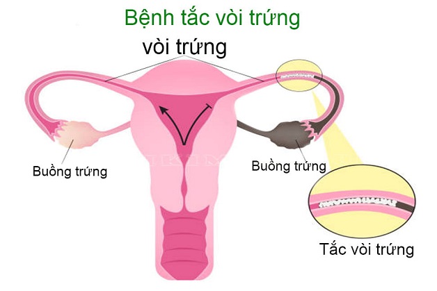 Cảnh báo: tắc vòi trứng có thể gây vô sinh hiếm muộn