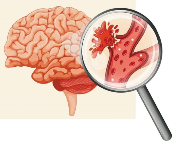 Cảnh báo triệu chứng đột quỵ ở người trẻ