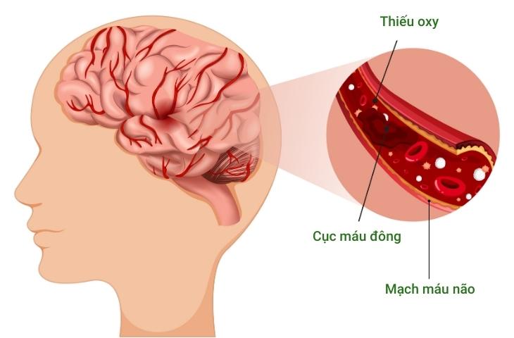 Cảnh báo yếu tố nguy cơ dự đoán trước đột quỵ não