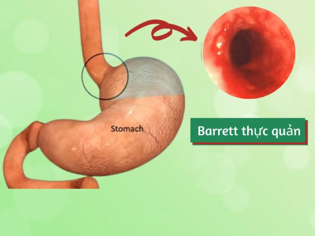 Cảnh giác trước biến chứng trào ngược dạ dày