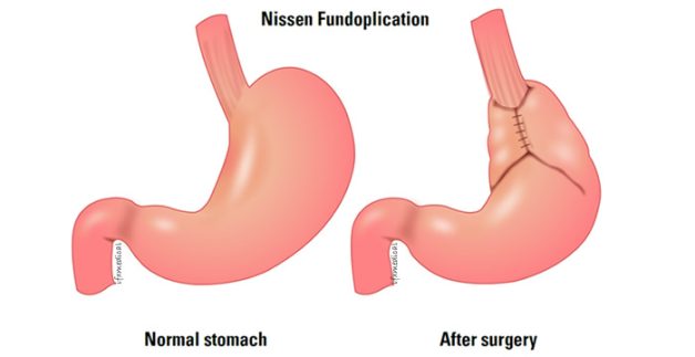 Cảnh giác trước biến chứng trào ngược dạ dày