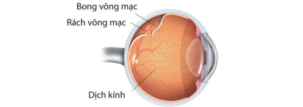 Cảnh giác trước dấu hiệu rách võng mạc