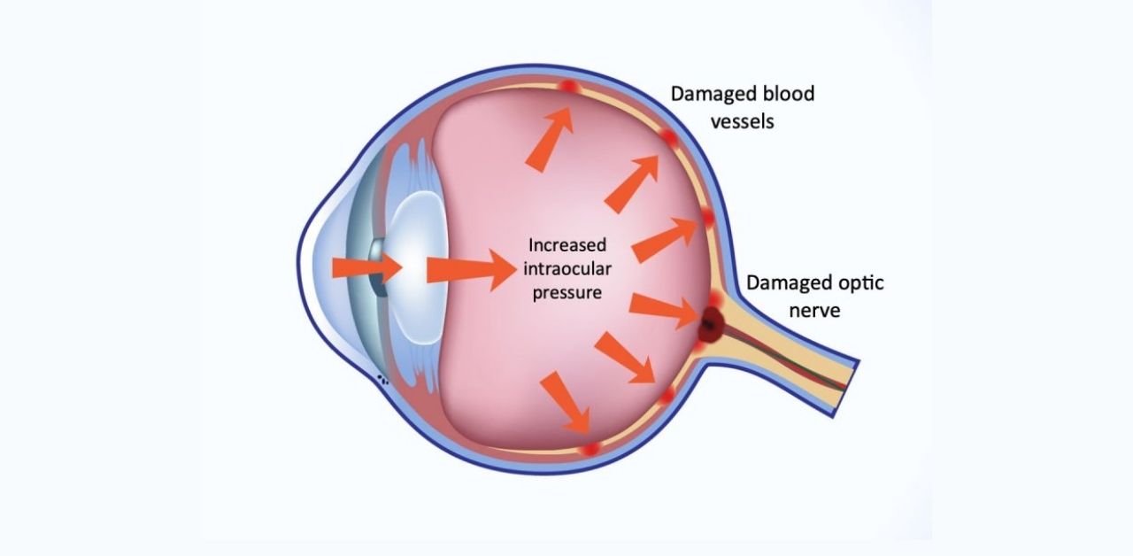 Cảnh giác với các dấu hiệu bị tăng nhãn áp