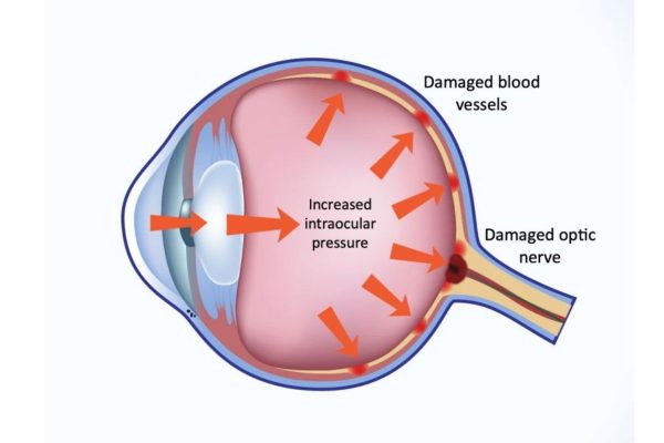 Cảnh giác với các dấu hiệu bị tăng nhãn áp