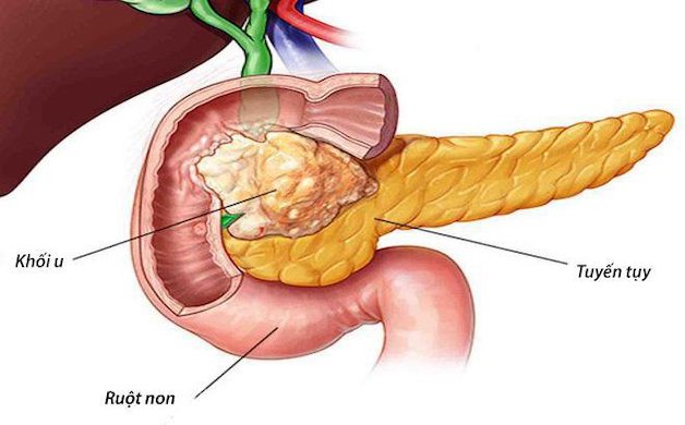 Cảnh giác với căn bệnh ung thư tuyến tụy ở nam giới