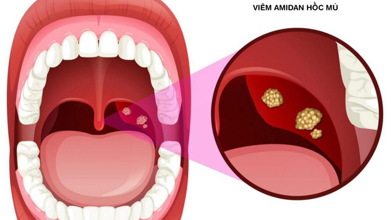 Cảnh giác với căn bệnh viêm amidan hốc mủ