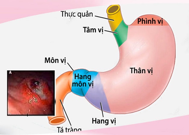 Cảnh giác với loét nông dạ dày hang vị 