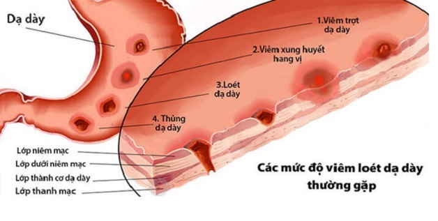 Cảnh giác với loét nông dạ dày hang vị 