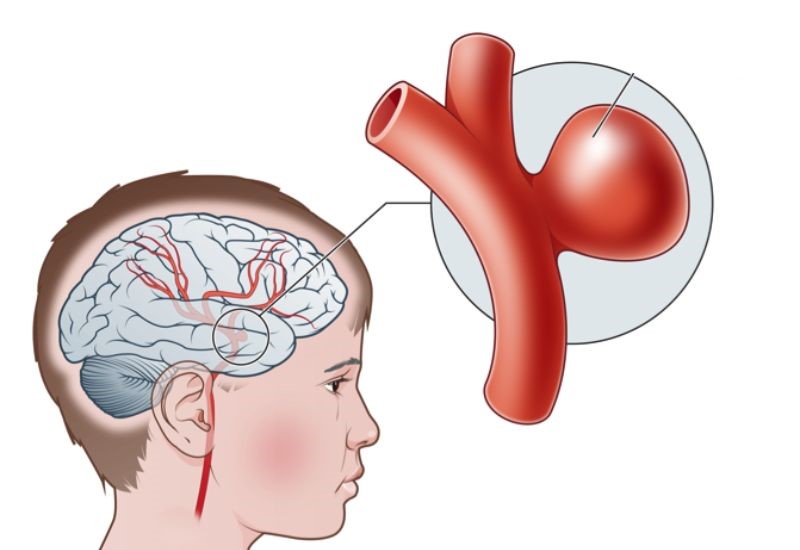 Cảnh giác với phình mạch não ở người trẻ