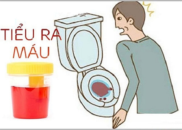 Cảnh giác với viêm đường tiết niệu tiểu ra máu