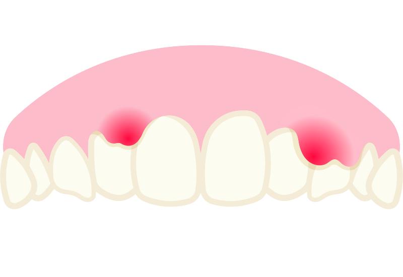 Cao răng bị vỡ: Hướng dẫn xử lý đúng cách