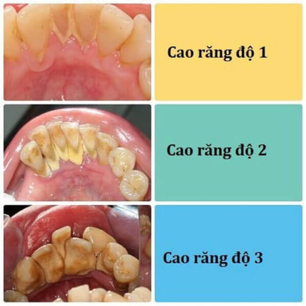 Cao răng độ 2: mức độ ảnh hưởng và cách xử lý