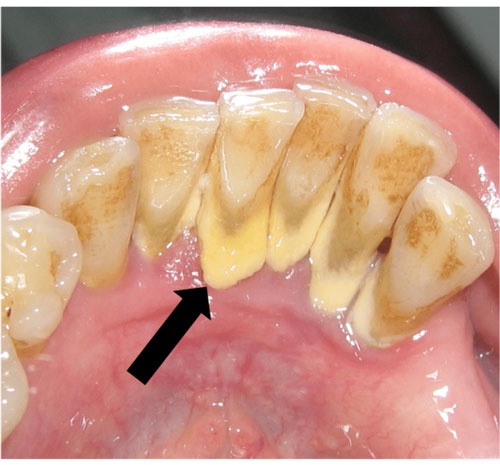 Cao răng độ 2: mức độ ảnh hưởng và cách xử lý