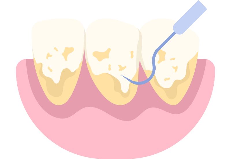 Cao răng là gì, giải đáp của chuyên gia