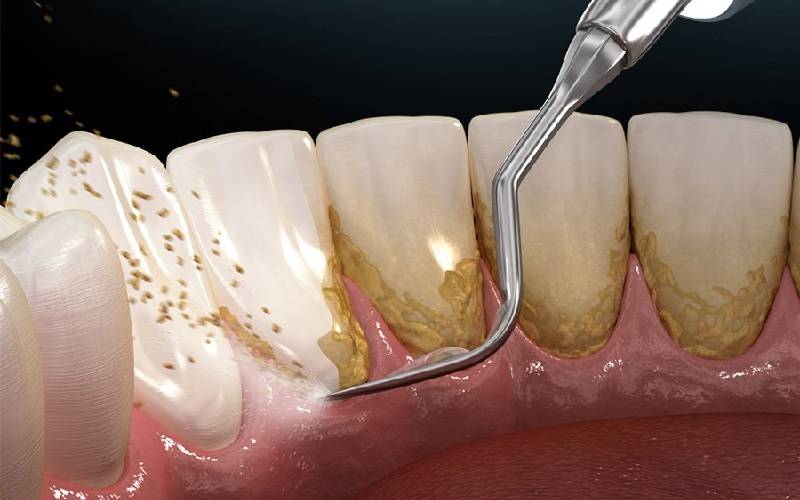 Cạo vôi răng giá thành hiện nay và những lưu ý khi thực hiện