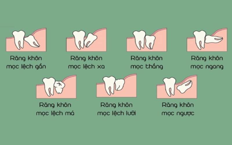 Cập nhật chi phí nhổ răng khôn hiện nay