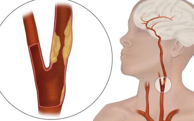 Cập nhật điều trị nhồi máu não sau chấn thương động mạch cảnh